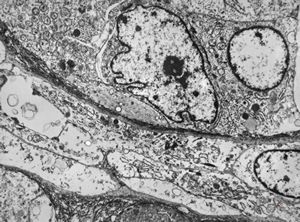 F,76y. | unspecified sarcoma (myocarcoma v.s.) - calf F,76y. | unspecified sarcoma (myocarcoma v.s.) - calf